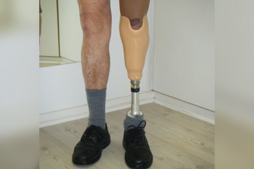 Above Knee Prosthesis