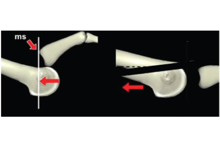 Shaving or Removing Bones