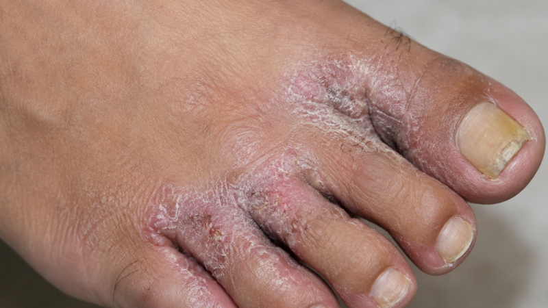 Fungal Foot Infection in Vizianagaram: Causes, Symptoms and Treatment