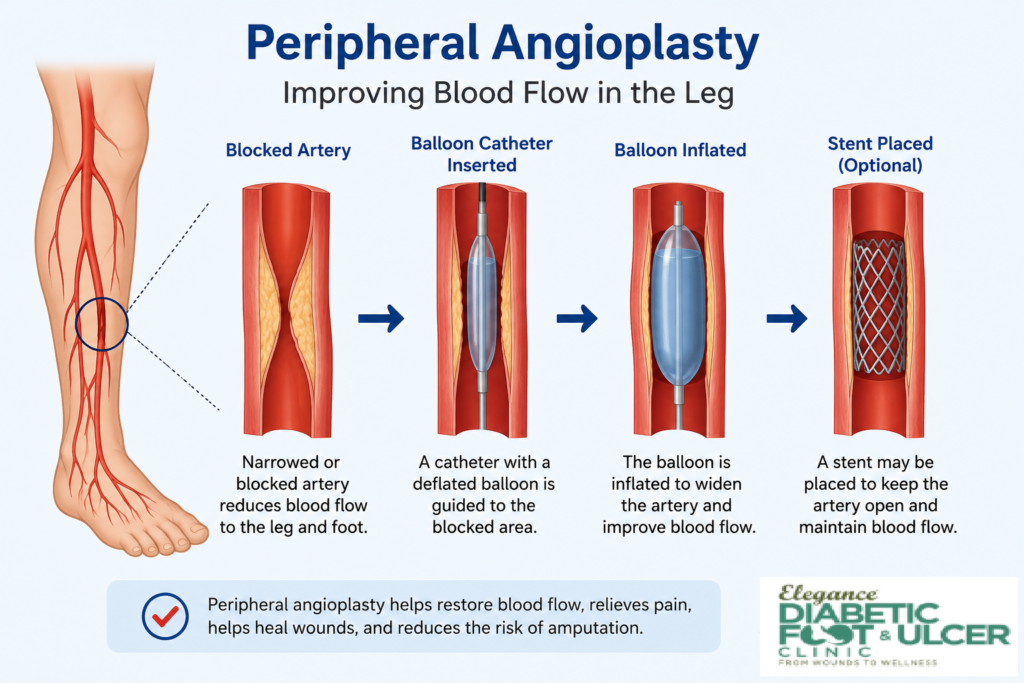 Peripheral Angioplasty in Surat