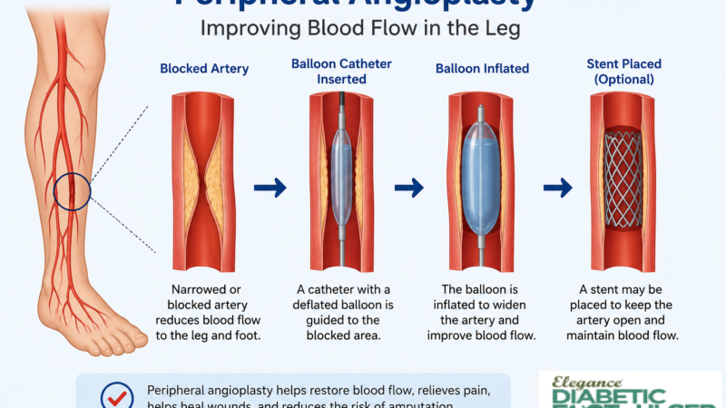 What Is Peripheral Angioplasty and When Is It Needed for Diabetic Foot?