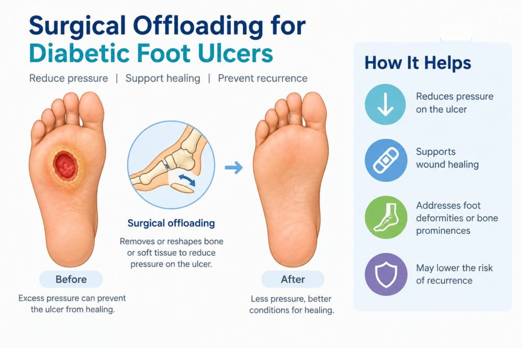 surgical offloading diabetic foot