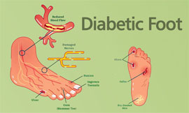 Surgical Diabetic Foot Care