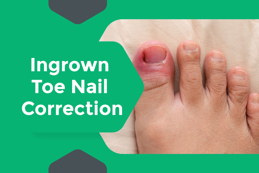 How to treat Ingrown Toenails - Footsmart Podiatry