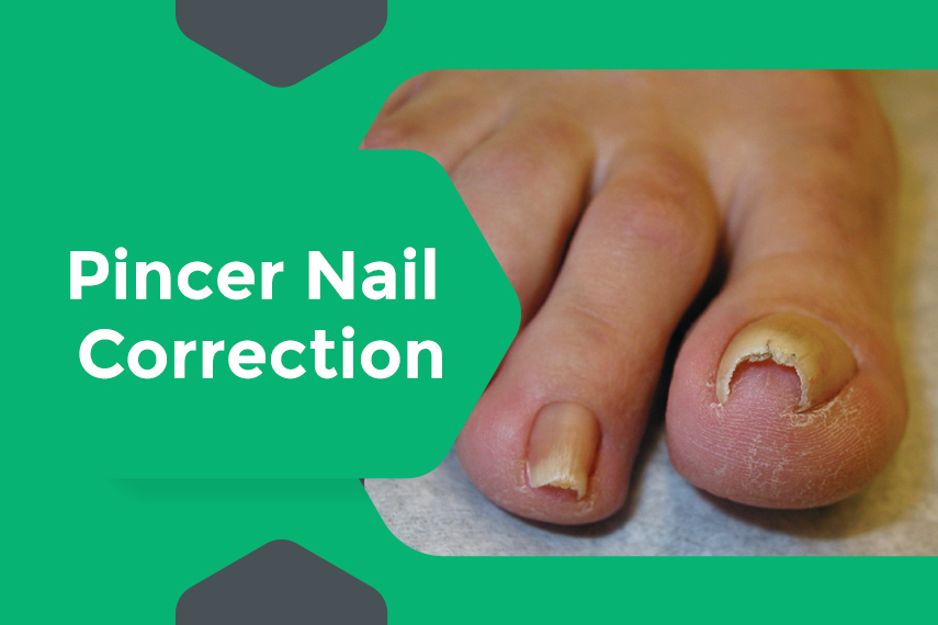 Typical appearance of pincer nail. Transverse overcurvature of the nail...  | Download Scientific Diagram