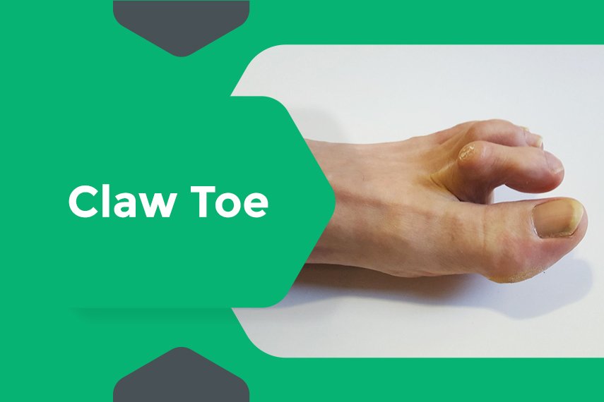 Treatment For Claw Toe Pain Claw Toe Meaning Radiowelle Nrw
