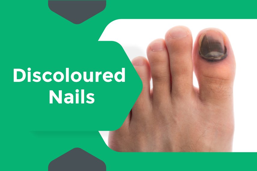 What Is Onychomycosis (Nail Fungus), and What Does It Look Like? - GoodRx